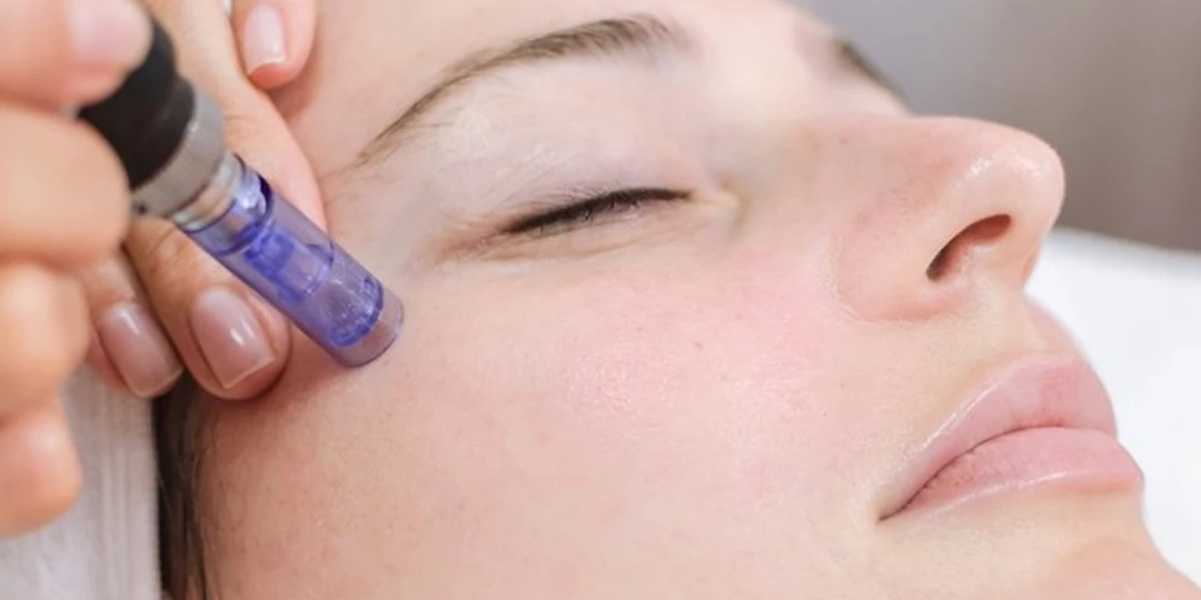 Beneficios del tratamiento dermapen