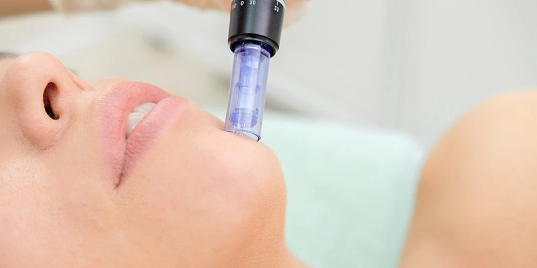 Cómo se realiza el tratamiento dermapen