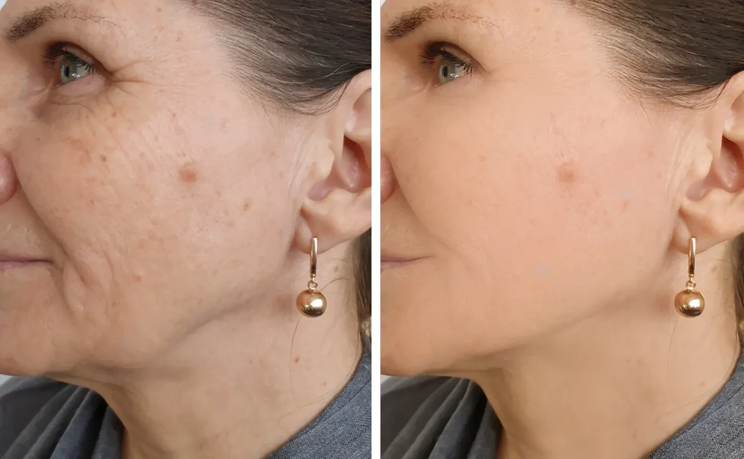 Resultados de dermapen Rejuvenecimiento facial inmediato